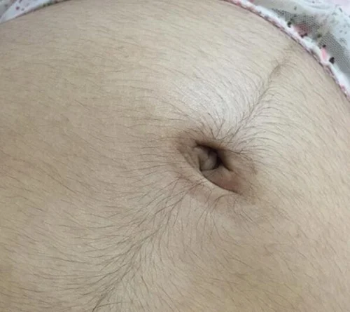 Nguyên nhân gây ra lông bụng khi mang thai